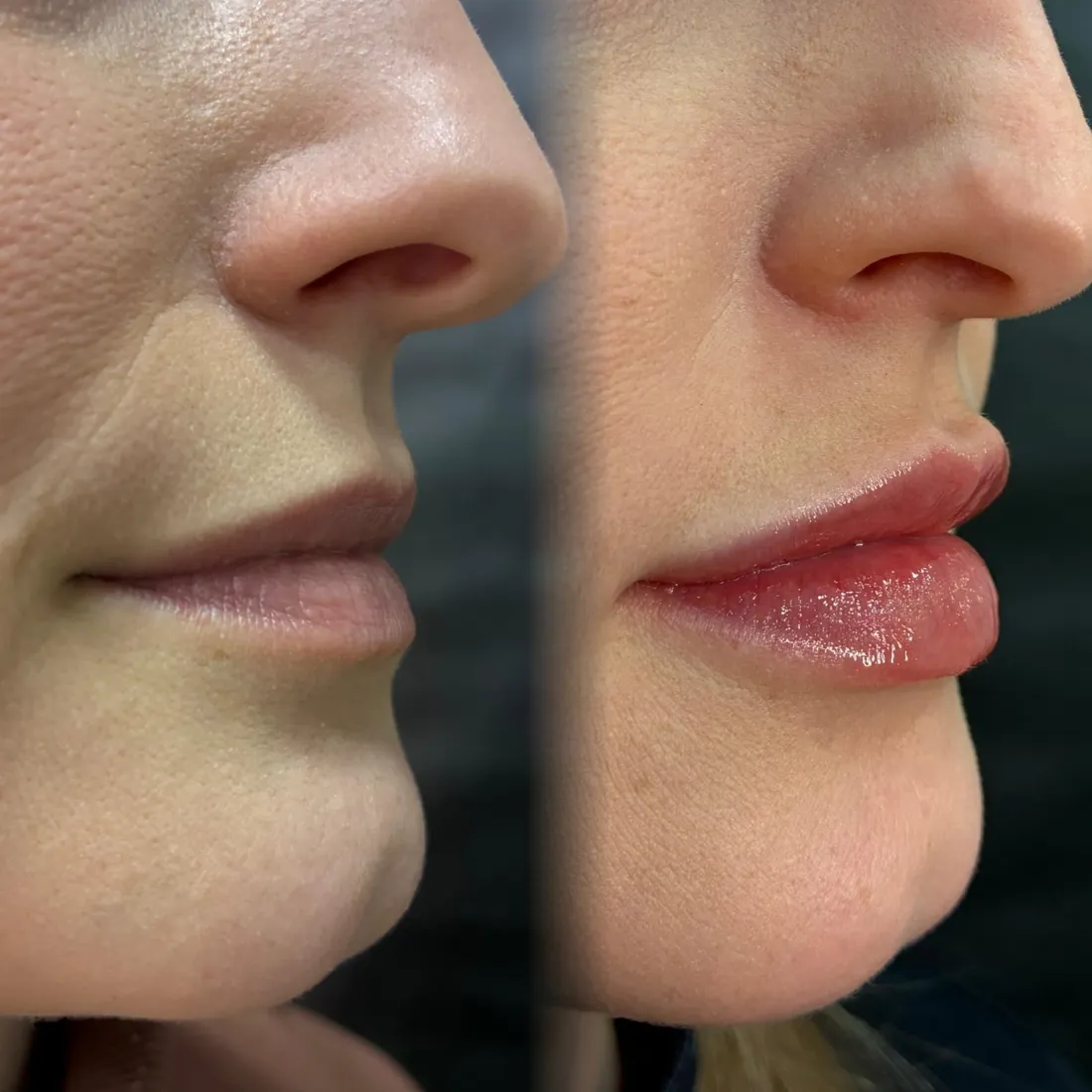 Fotografia original do protocolo Preenchimento Labial da Virtuosa